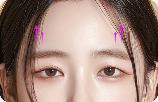 처진눈매교정
