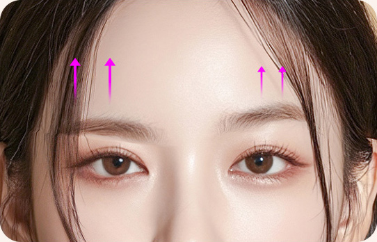 비대칭 눈썹교정