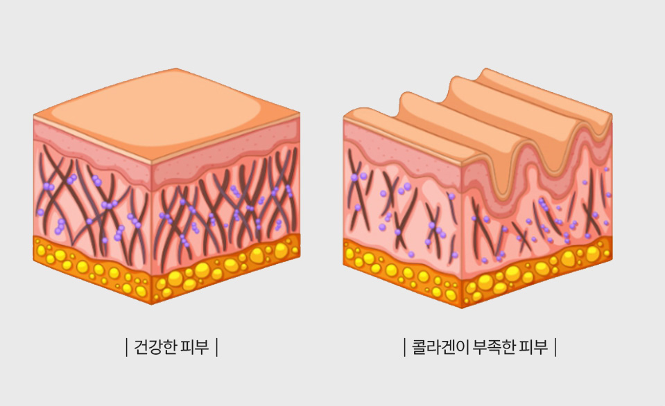 건강한 피부와 콜라겐이 부족한 피부 비교