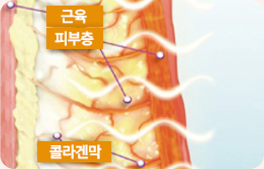 고주파 열에너지 전달