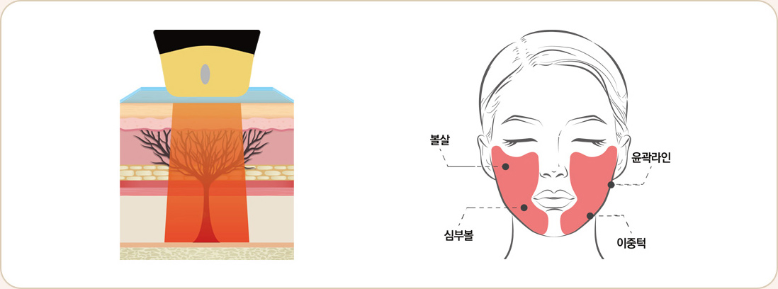 티타늄 리프팅 및 컨투어링
