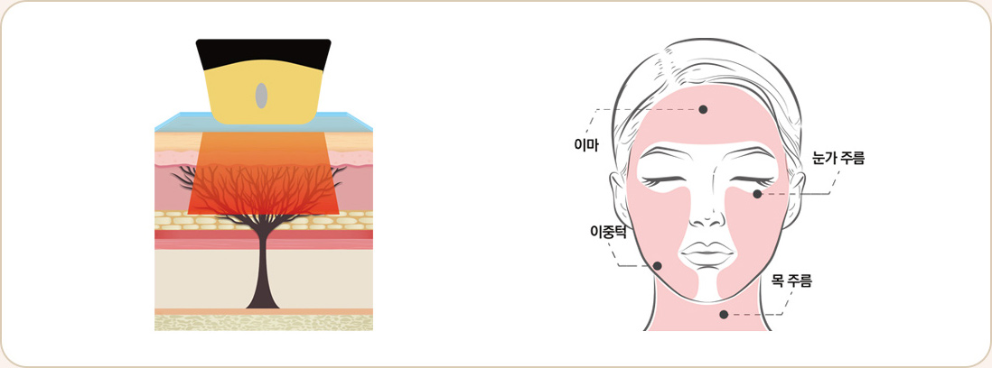 티타늄 타이트닝 및 미백